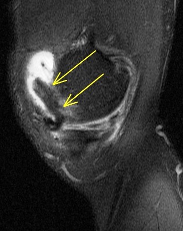 Figure 6 for case Unstable flap tear, medial meniscus